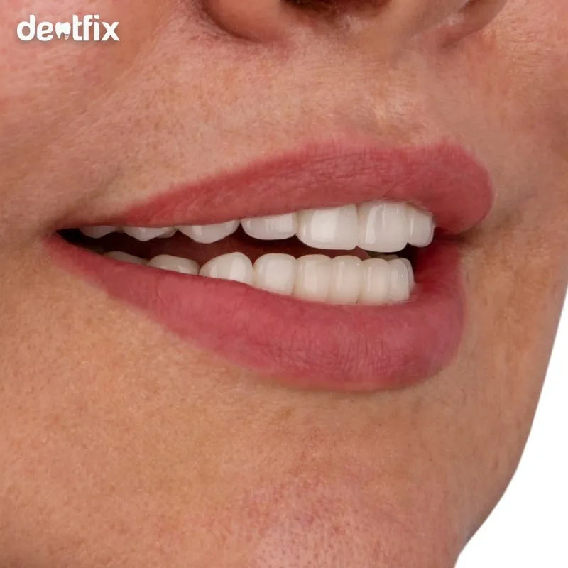 Veneers-Tuerkei_nachher