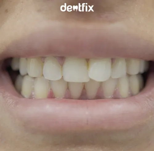 Zahnbehandlung 2 vorher Dentfix