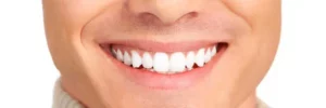 mit-veneers
