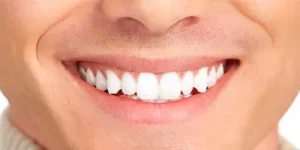 mit-veneers